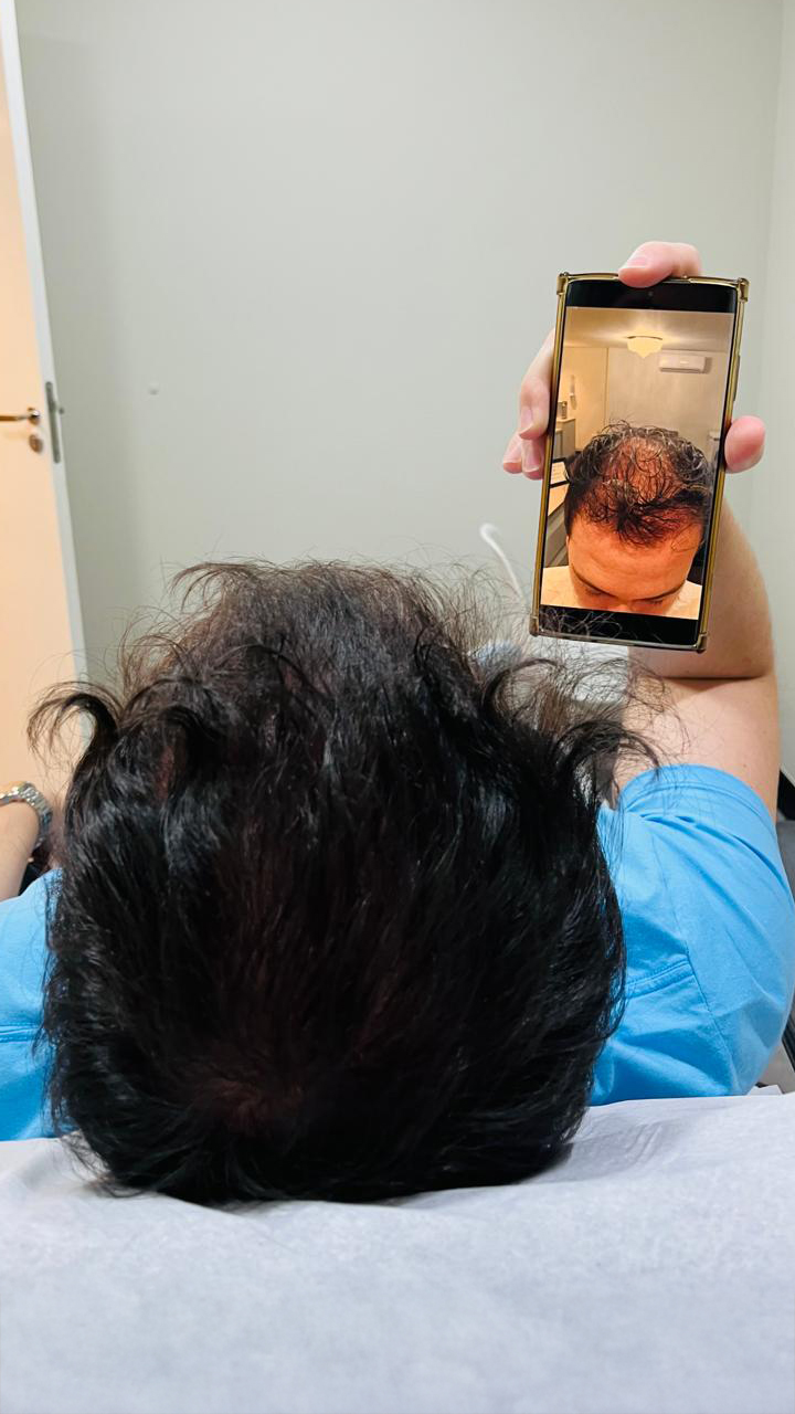 Resultado real de paciente Dr Hair