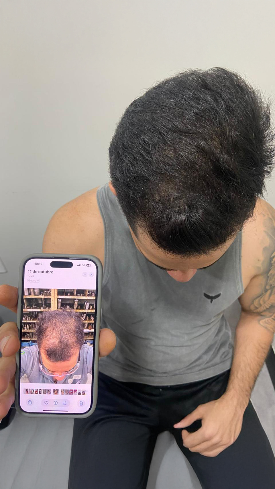 Resultado real de paciente Dr Hair